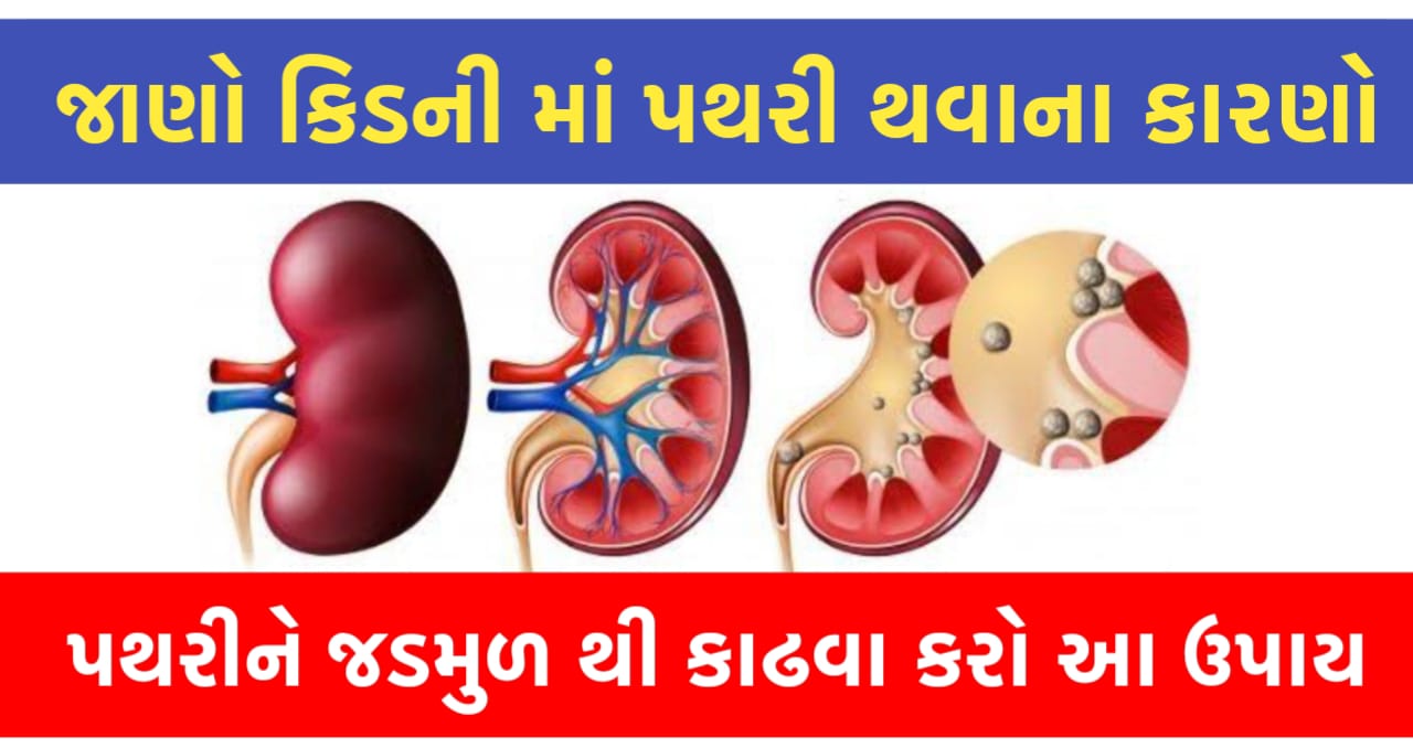 Know the causes of kidney stones